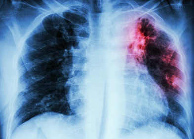 Fibrose Pulmonaire Idiopathique Symptomes Traitement Sante Sur Le Net