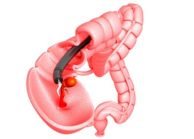 Polypes Intestinaux Definition Diagnostic Et Traitement Sante Sur Le Net